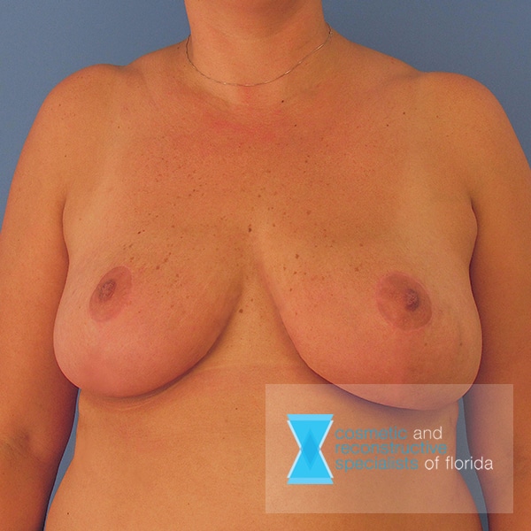 after breast reduction fort lauderdale FL