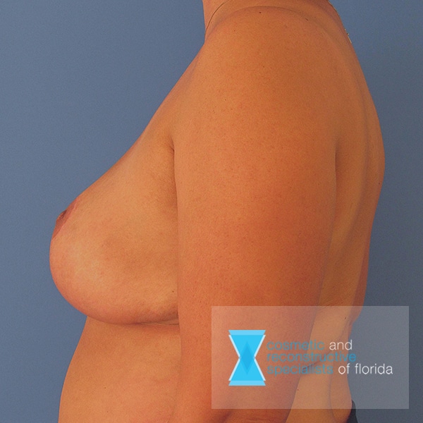 breast reduction after procedure fort lauderdale FL
