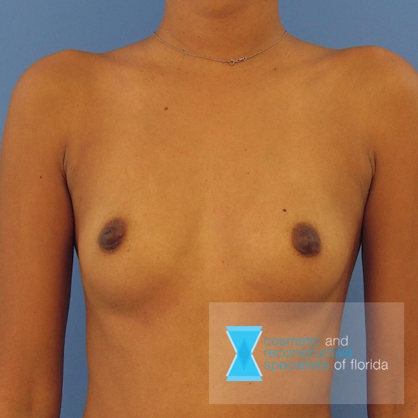 breast augmentation before image fort lauderdale FL