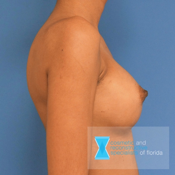 breast implants after image fort lauderdale FL