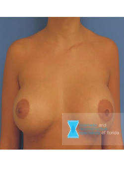 Breast Augmentation