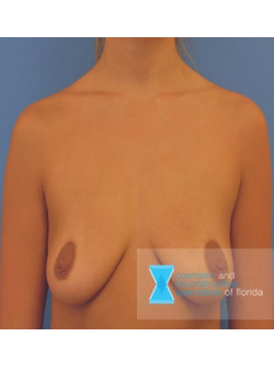 Breast Augmentation