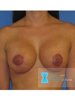 Breast Augmentation and Lift