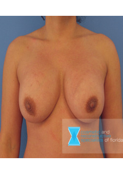 Breast Implant Revision