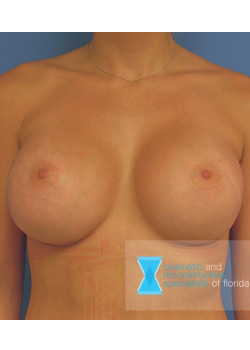 Breast Implant Revision