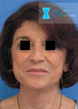 Facelift & Neck Lift