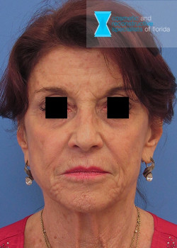 Facelift & Neck Lift