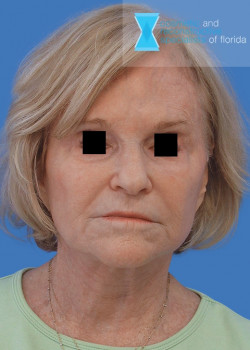 Facelift & Neck Lift