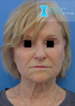 Facelift & Neck Lift