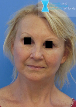 Facelift & Neck Lift