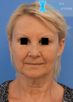 Facelift & Neck Lift