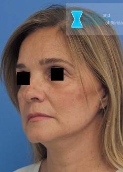 Facelift & Neck Lift