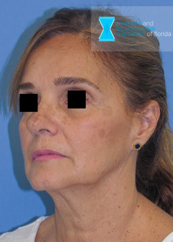 Facelift & Neck Lift