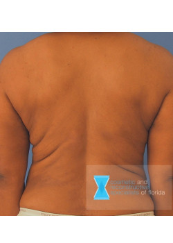 Liposuction