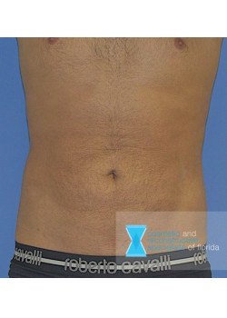 Liposuction