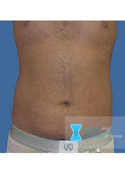 Liposuction